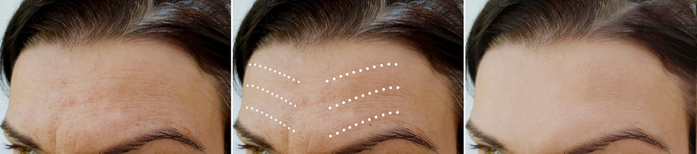 Forehead before, during, and after Botox with wrinkles reduced.